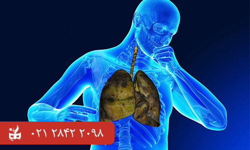 علت بیماری COPD - انسداد ریوی مزمن (COPD)