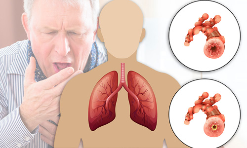 انسداد ریوی مزمن (COPD)
